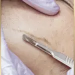 Dermaplaning Facial